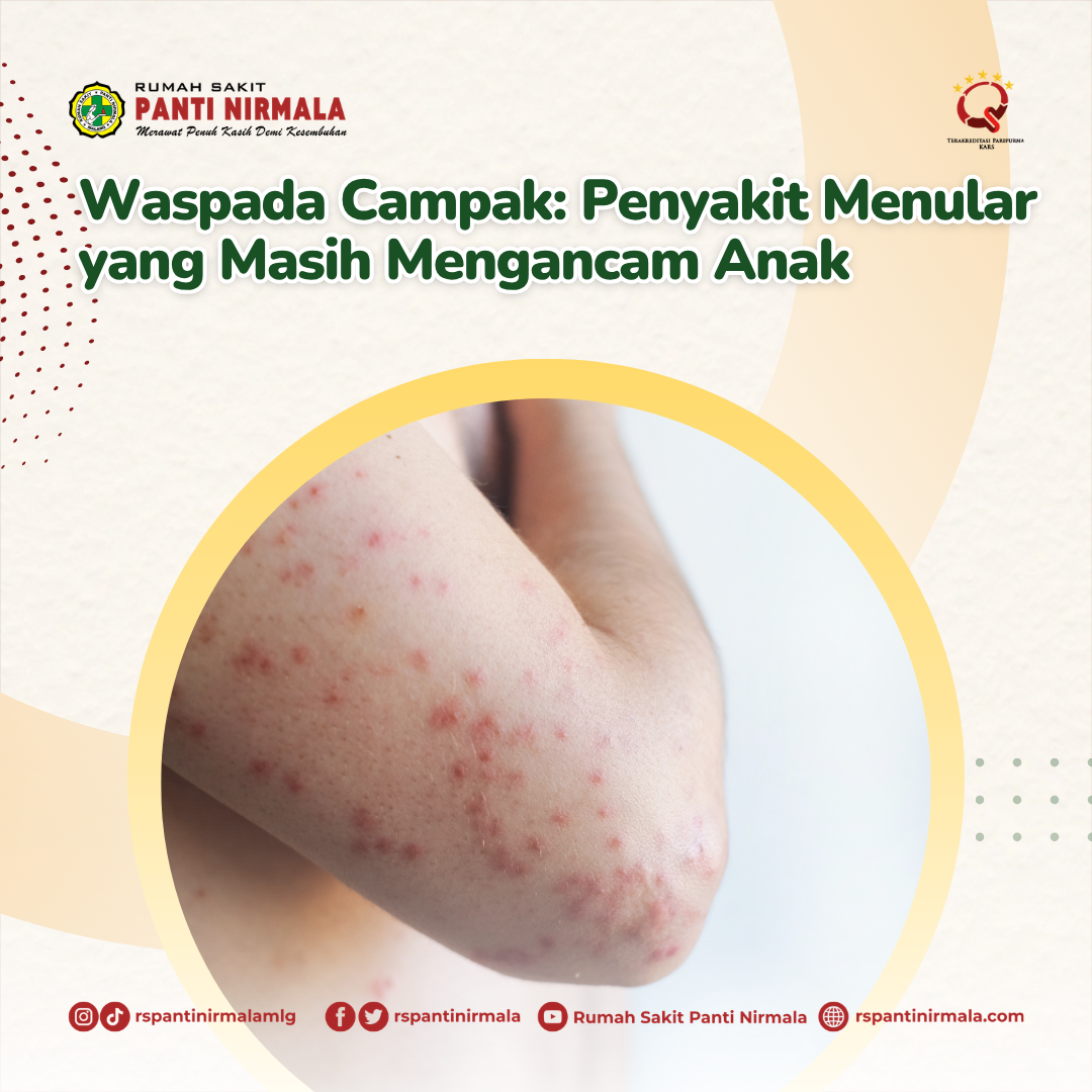 Waspada Campak: Penyakit Menular yang Masih Mengancam Anak