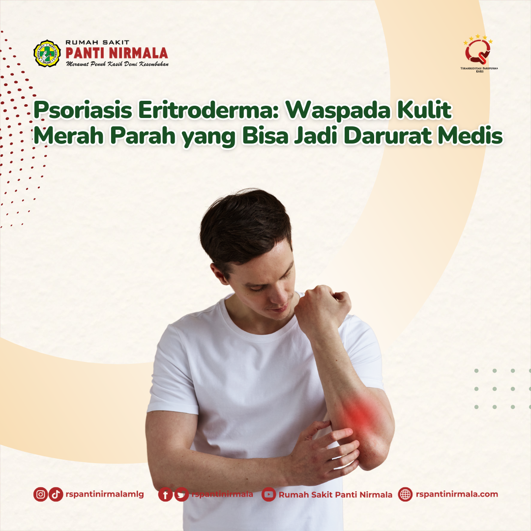 Psoriasis Eritroderma: Waspada Kulit Merah Parah yang Bisa Jadi Darurat Medis
