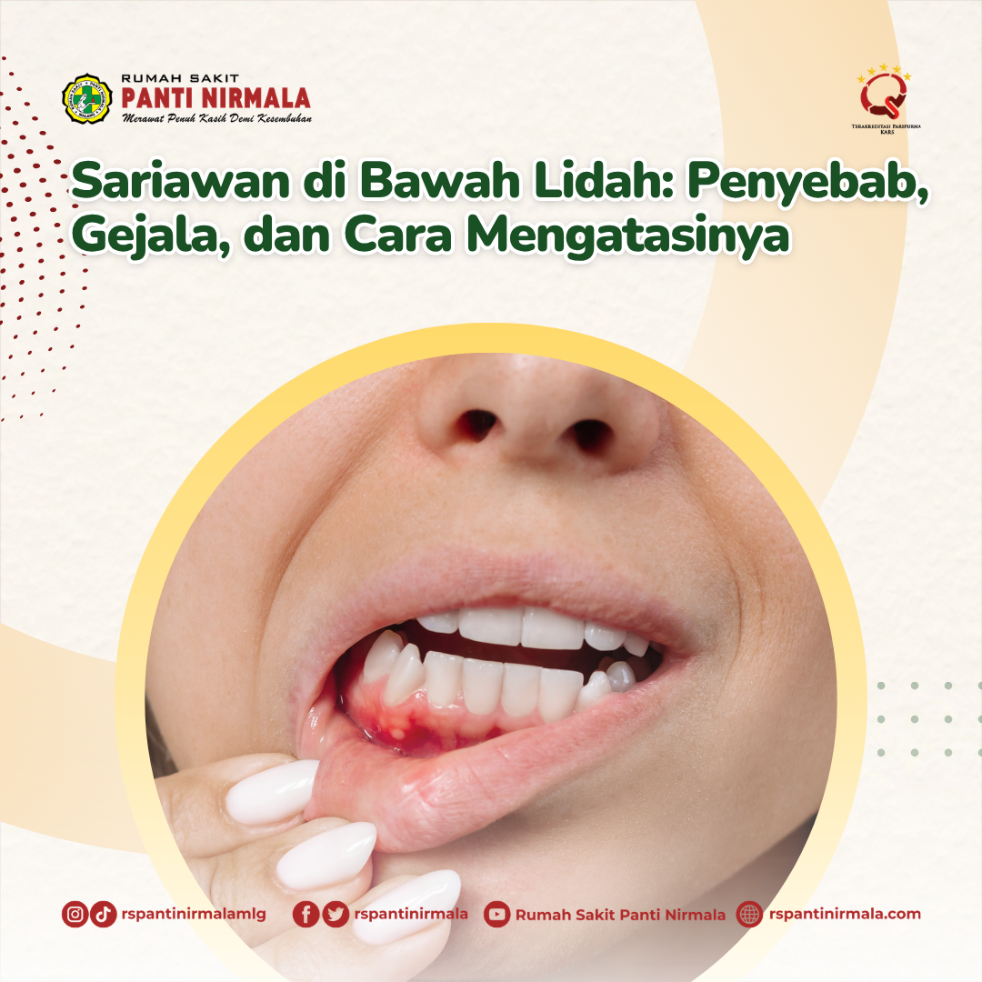 Sariawan di Bawah Lidah: Penyebab, Gejala, dan Cara Mengatasinya